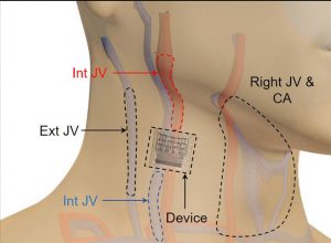 UCSD-ultrasound-patch